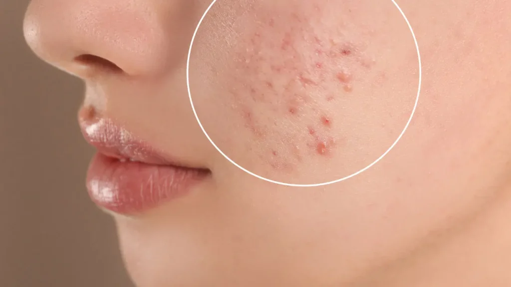 Acne.